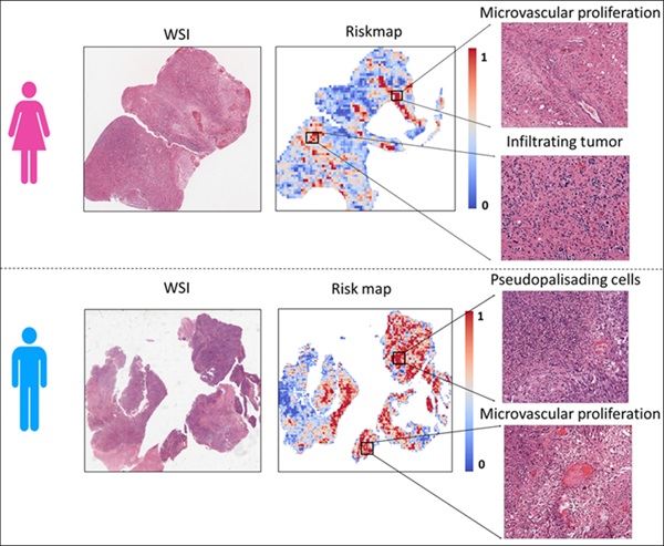 Las imágenes muestran regiones de tumores de glioblastoma en mujeres (arriba) y hombres (abajo). Los modelos de IA predicen la presencia de áreas de riesgo relativamente más alto (rojo) y de menor riesgo (azul) (Foto cortesía de Tiwari Lab/UW -Madison)